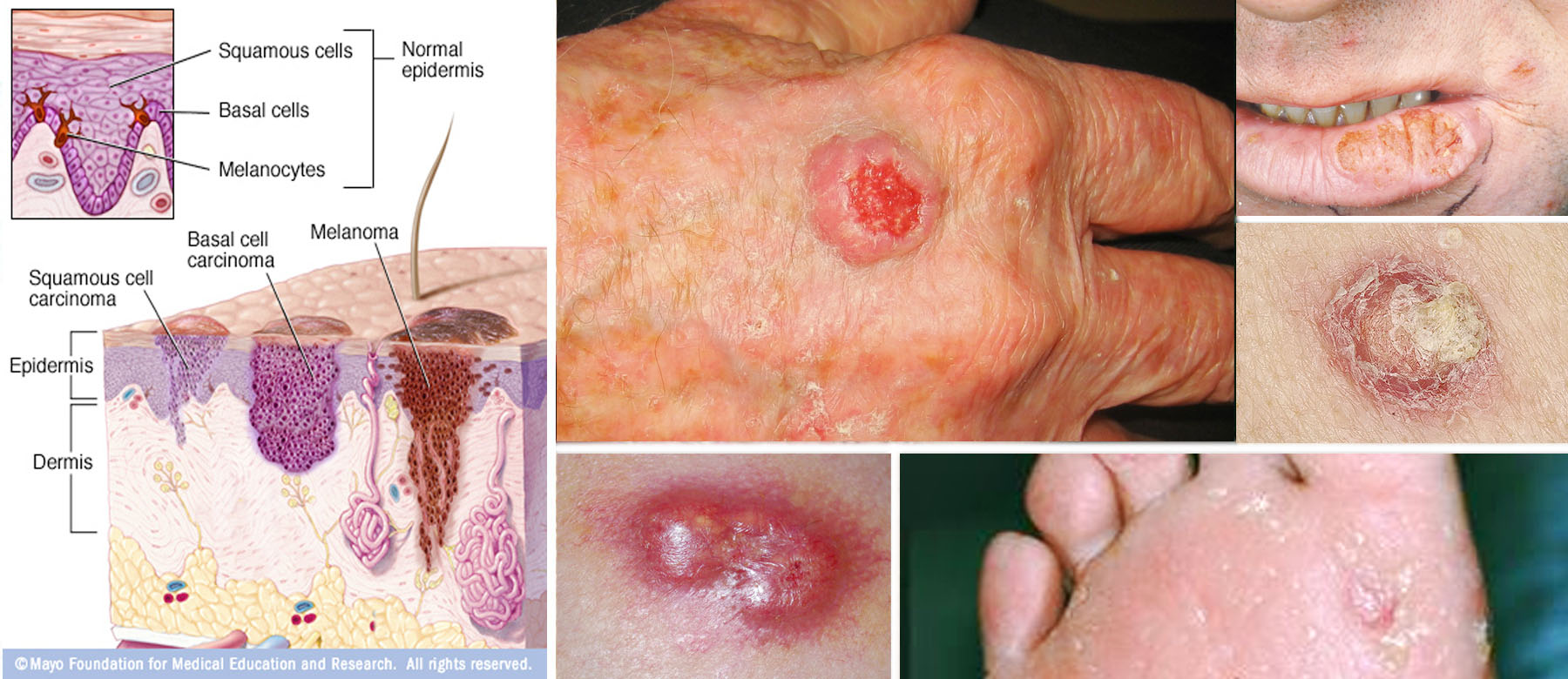 Squamous Cell Carcinoma of Skin. Symptoms and Treatment